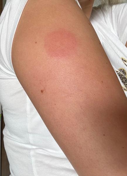 Prečo mám po uštipnutí teplú pokožku?