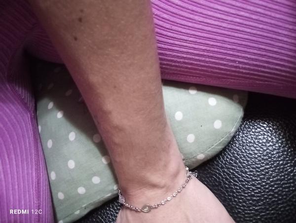 Čo spôsobuje hrčky na žile?