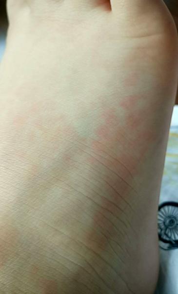 Zvýšená teploza a výsyp na nohách