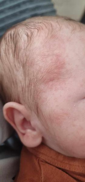 Ako liečiť novorodenecké akné?