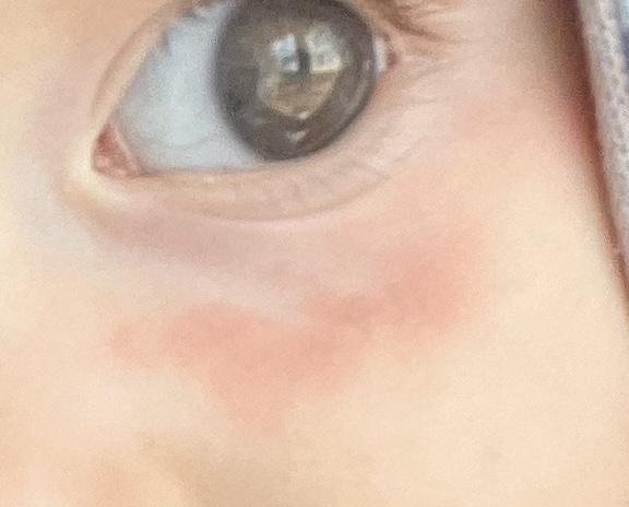 Fľak pod okom po pobyte vonku