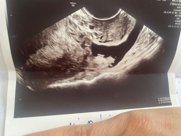 Čo znamenajú cysty a hCG 160 v 4. týždni tehotenstva?