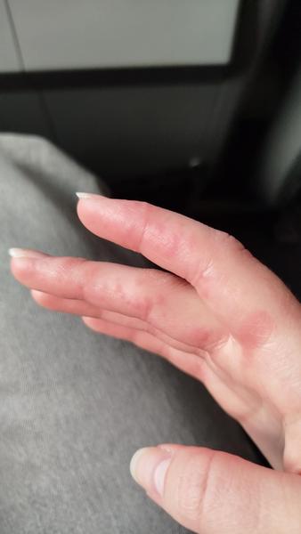 Kožné vyrážky u detí