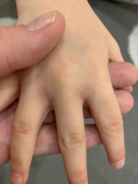 Aké suché miesta medzi prstami má moja štvorročná dcérka?