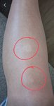 Je vitiligo príčinou straty pigmentu a bielych škvŕn?