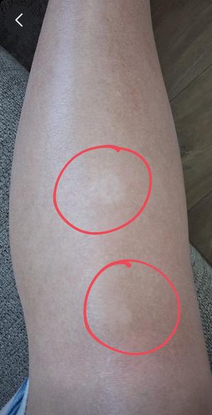 Je vitiligo príčinou straty pigmentu a bielych škvŕn?
