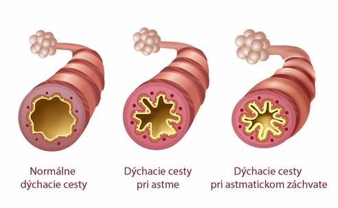 Astma Astma