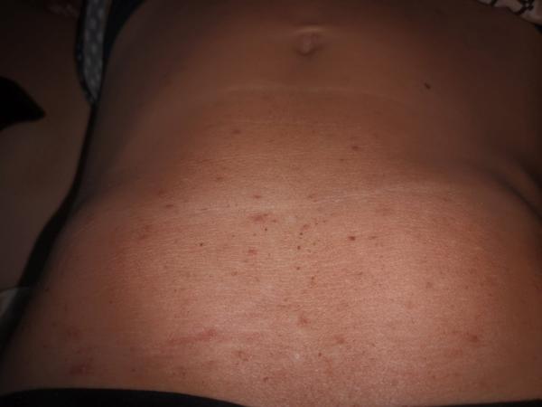 Kožné vyrážky na bruchu