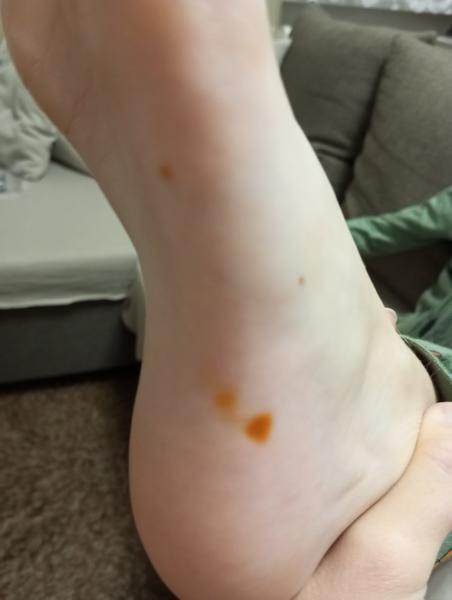 Oranžovo-hnedé bodky na chodidle: Čo to môže byť?
