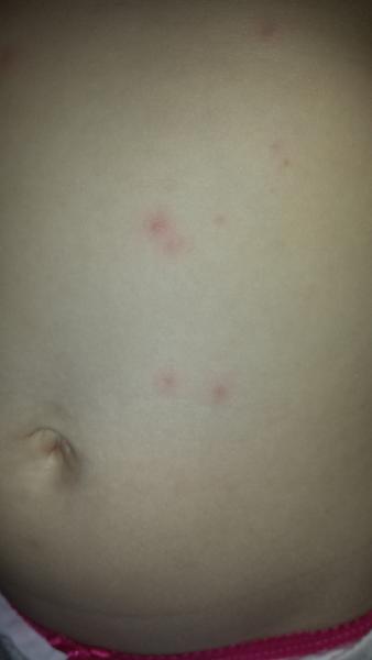 Čo znamenajú tieto vyrážky?