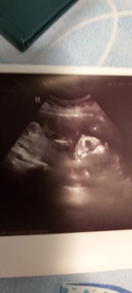 Aké je pohlavie môjho bábätka v brušku?