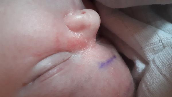 Je to alergia/exém u 2-týždňového bábätka??