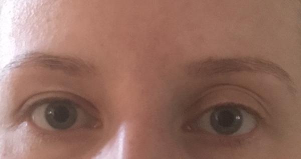 Znamená nesúrmernosť očí zdravotný problém?