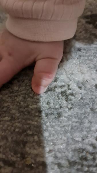 Je to kurie oko či ovčie kiahne?