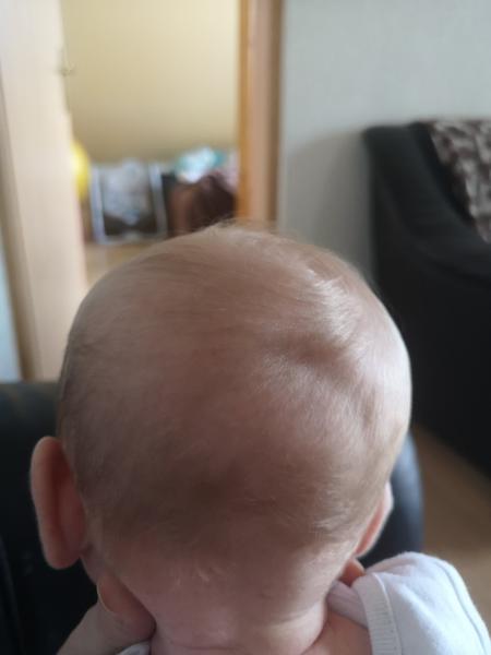 Mesačná dcérka má vzadu na hlavičke priehlbinku