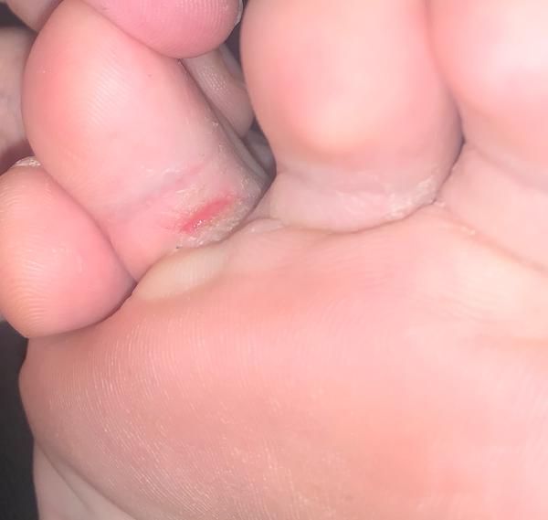 Možná pleseň medzi prstami