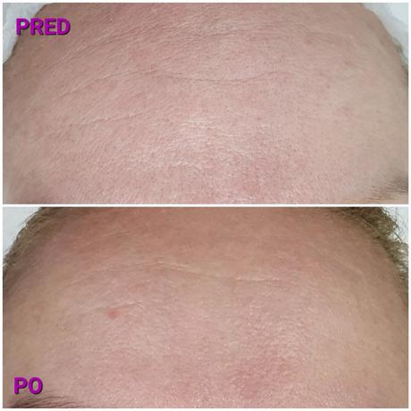 Radiothermolifting - omladenie rádiofrekvenciou, 