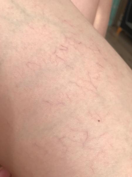 Sú toto kŕčové žily?