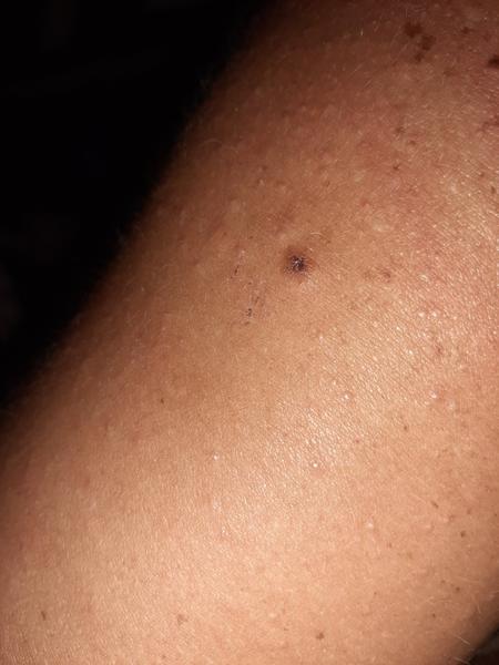 Mám ísť s týmto znamienkom k doktorovi?