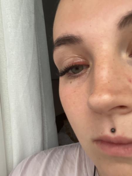 Je to naozaj jačmeň na oku?