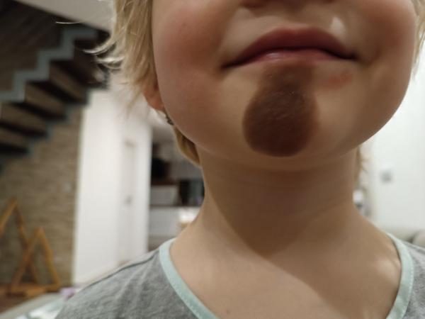 Aké sú riziká skorého odstránenia znamienka u 3-ročného dieťaťa?