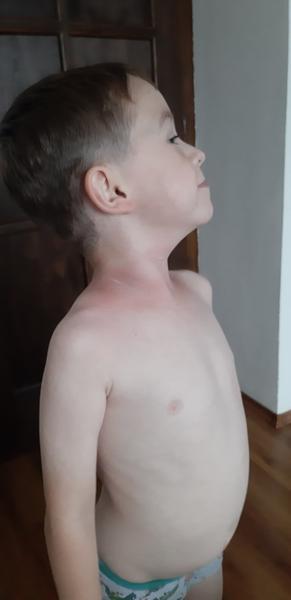 Zrejme alergia na ovocie?