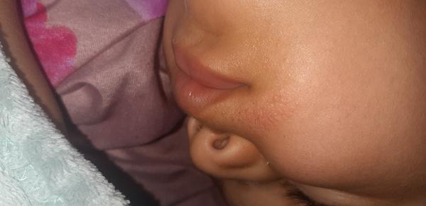 Help - čo sú to za vyrážky?