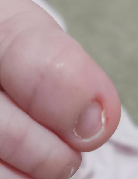 Ako riešiť zarastajúci necht u dvojmesačného bábätka?