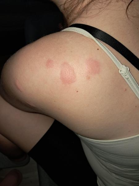 Červené svrbiace fľaky na tele