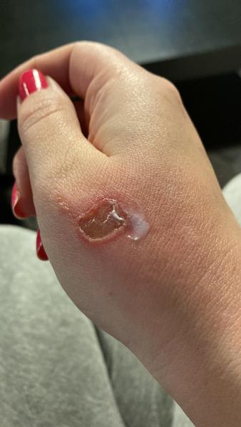 Popálenina - hojenie rany