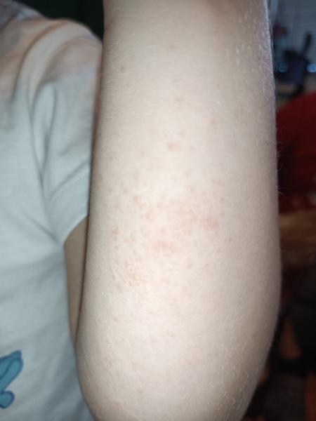 Zvláštny výsyp na ručičke