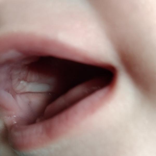 Čo znamená biely povlak v ústach dieťaťa?