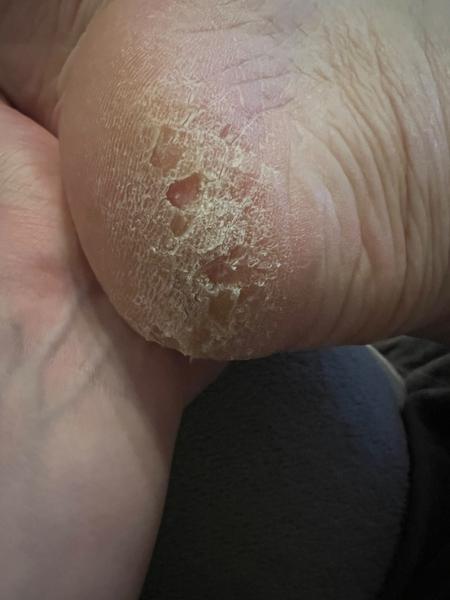 Tipy na odstránenie extrémne suchých piat