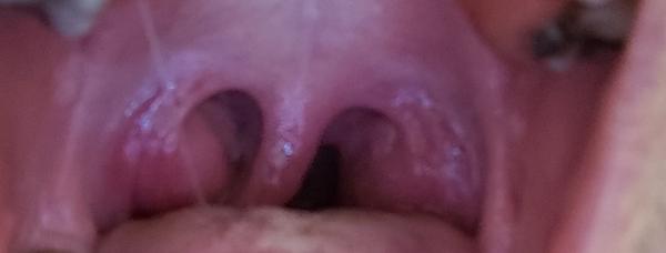 Mám naozaj opuchnuté mandle?