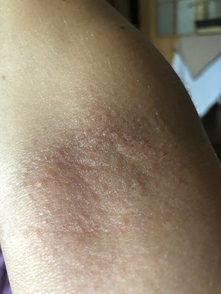 Vyrážky a svrbenie v záhyboch