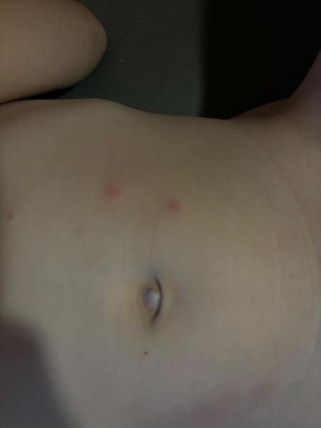 Môžu to byť kiahne?