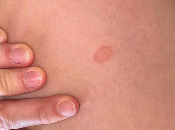 Môže byť toto borelióza?