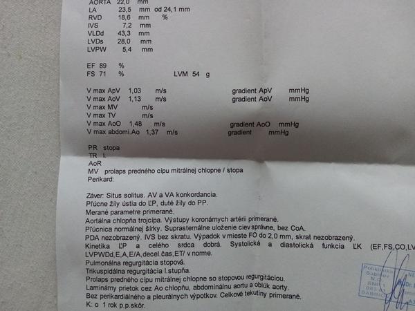 Čo je prolaps mitrálnej chlopne a aké sú riziká?