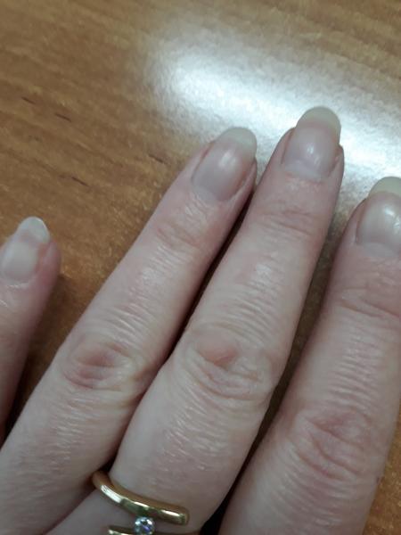 Čo je toto na zhybe prostredníka?