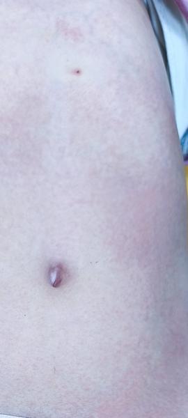 Možu byť vyrážky na celom tele príznakom choroby?