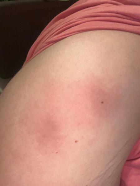 Aké bolestivé guličky mám pod kožou?