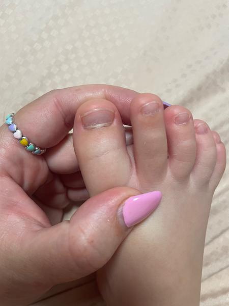 Oddelenie nechtu od kožičky, bodky na nechtoch