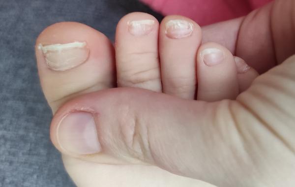 Z čoho môže mať môj 2,5-ročný syn lámavé nechty na nohách?