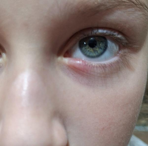 Čo robiť, keď dieťa zasiahne lopta do tváre?