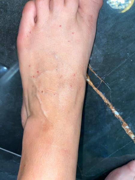 Čo spôsobuje zmenu na pravej nohe?