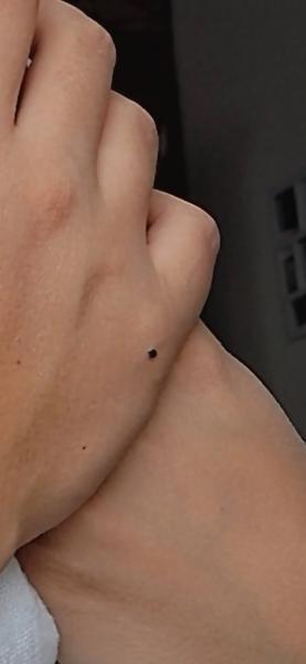 Čo robiť s čiernym znamienkom po pôrode?