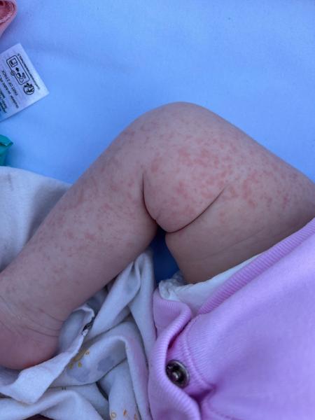 Výsyp u mesačného dieťaťa