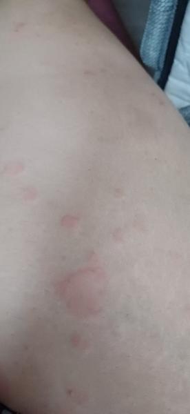 Má môj syn pityriasis rosea? Skúsenosti ostatných vítané