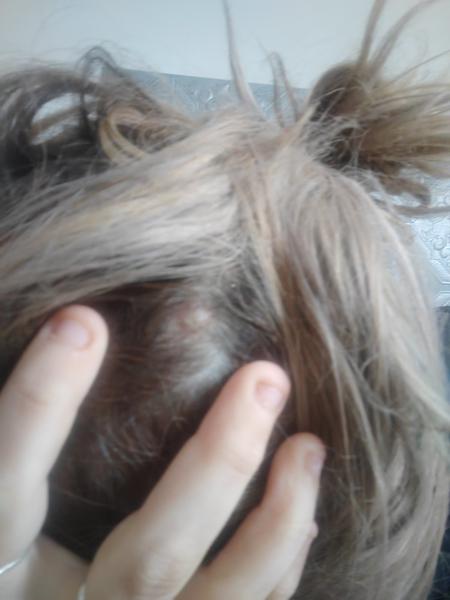 Riešenie problémov s pretrvávajúcim pupienkom a bolesťou