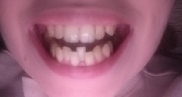 Túžba po krásnych zuboch